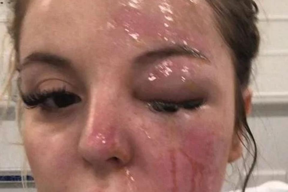 Bethany Rosser. O posto no microondas ovo acabou explodindo e atigiu o seu rosto Bethany Rosser. O posto no microondas ovo acabou explodindo e atigiu o seu rosto